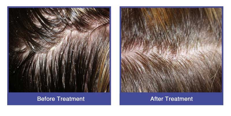 Eczema Eczema Hair Loss
