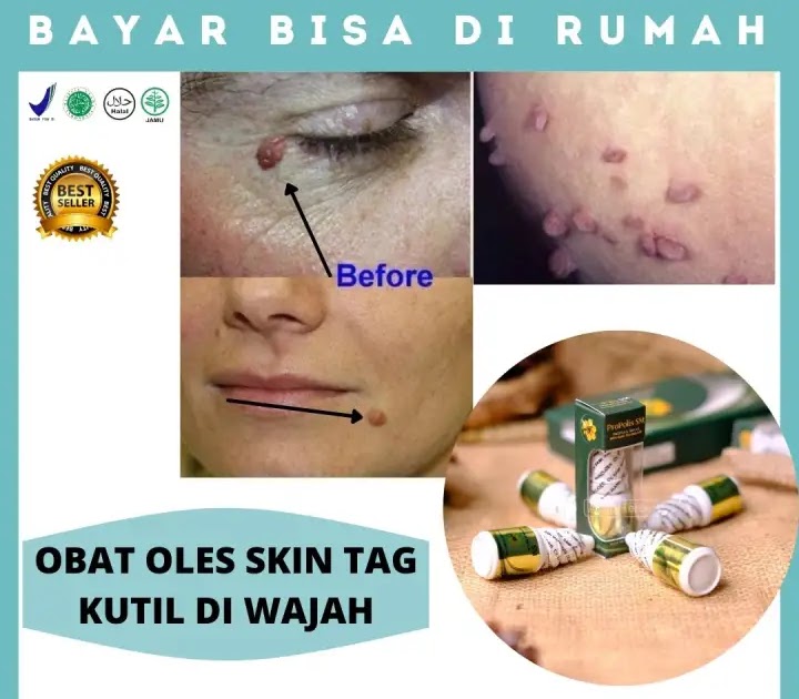 Gambar Daging Tumbuh Di Wajah - Daging tumbuh ini berukuran kecil dan