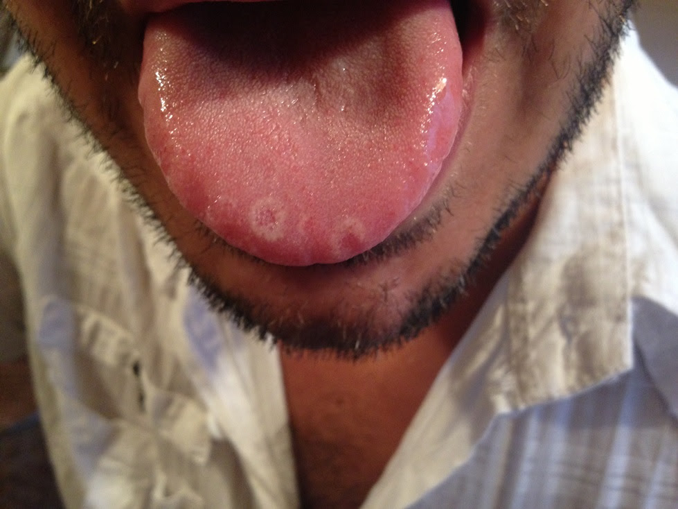 biopsia papilloma sulla lingua)