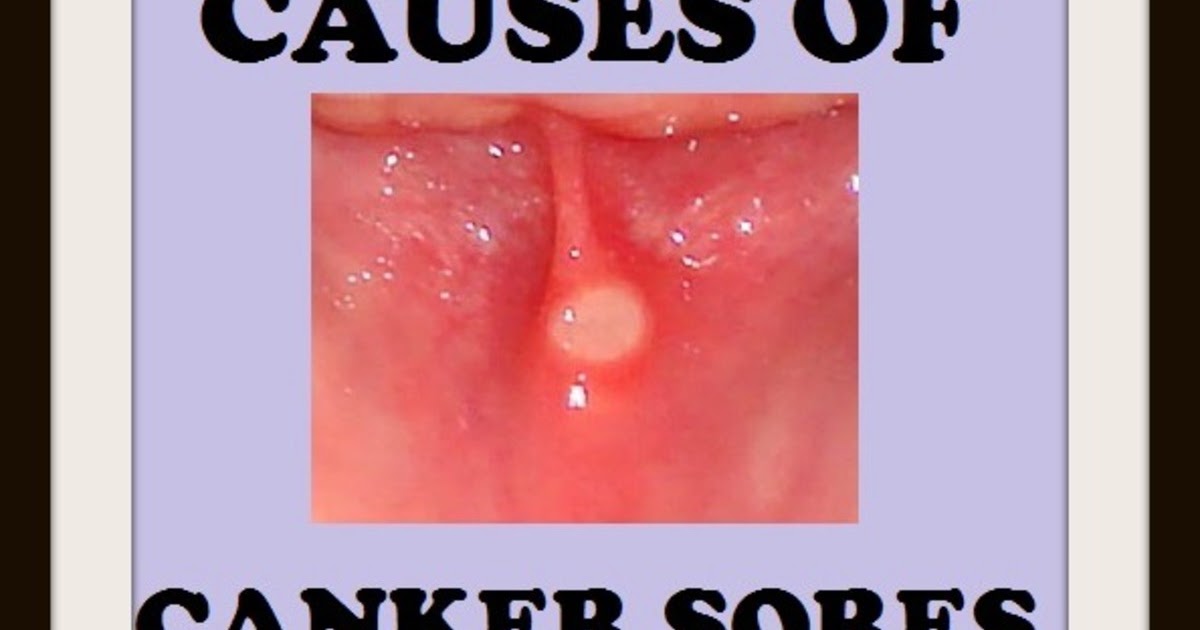 Can You Get Cold Sores On Your Gums Knitdesignerbd