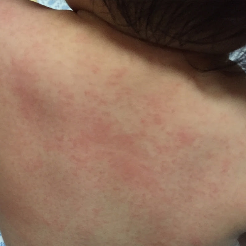 √1000以上 赤ちゃんアレルギー反応 画像 581937赤ちゃんアレルギー反応 画像