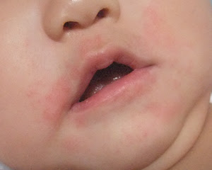 美しい花の画像 75 口周り 湿疹 子供