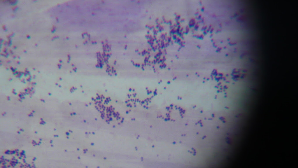 Staphylococcus aureus 3. Эпидермальный стафилококк на лице. Золотистый стафилококк прыщи.