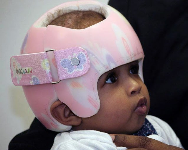 Rital Gaboura with her laser-designed pink helmet. She and her sister Ritag survived an operation to separate them after they were born joined at the head