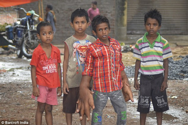Kaleem, a keen cricketer, said the teachers at his school have told him other children are 'scared' of his hands