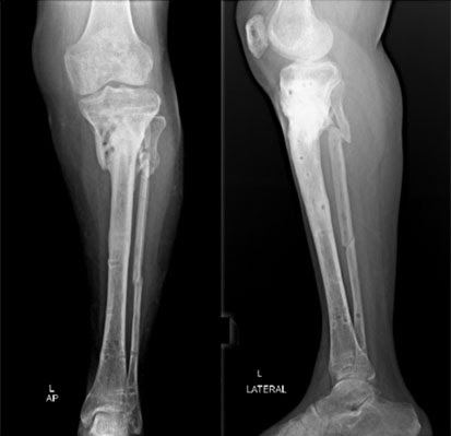 S. O. S. - "Osteomielitici d'Italia" - Onlus: (Scheda 232 ...