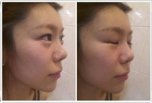 ID美容外科、鼻整形、鼻翼縮小、鼻筋