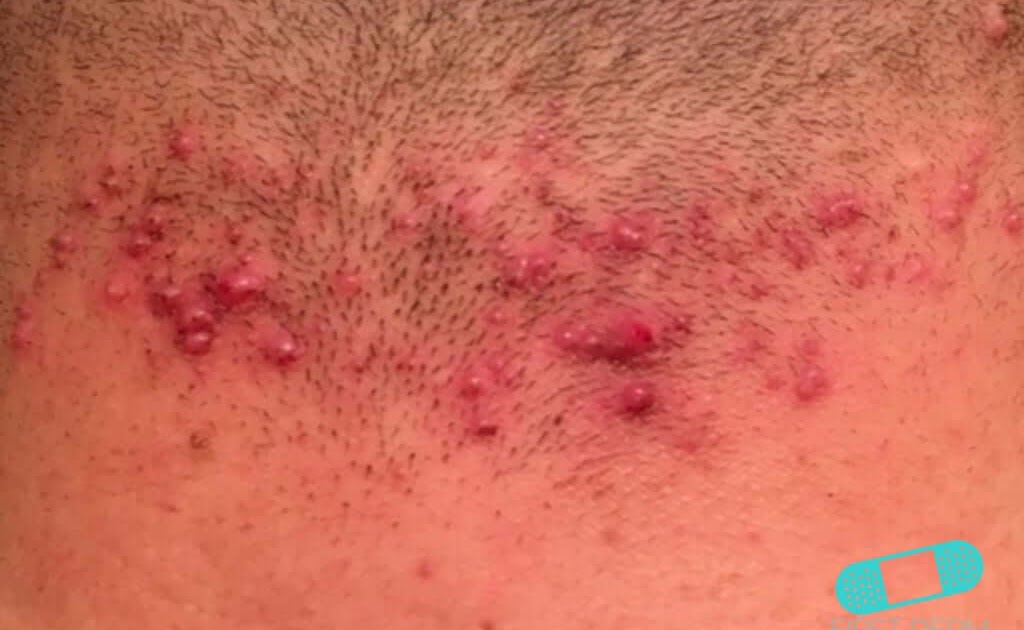 Bumps On Back Of Neck After Haircut Which Haircut Suits My Face