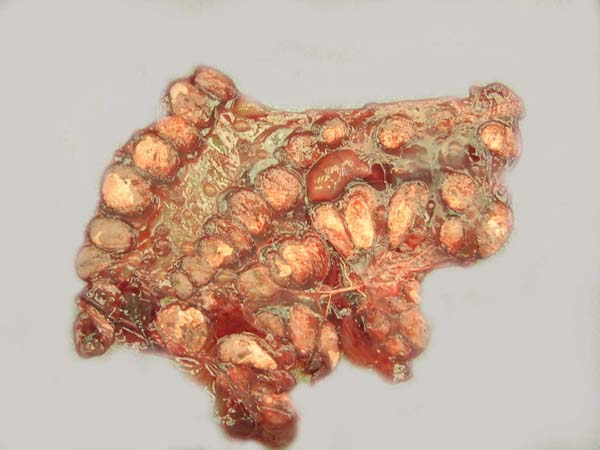 The placenta after removal from the uterus, showing the cotyledons arranged in basically four rows