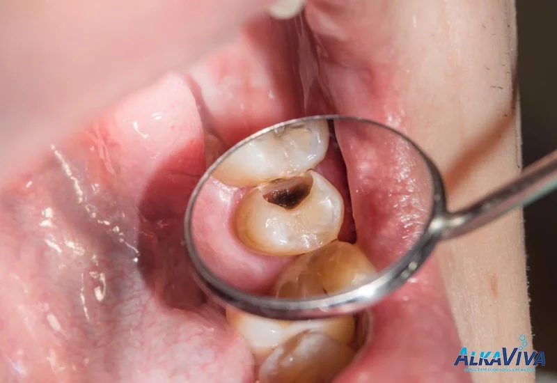 PHÒNG NGỪA BỆNH SÂU RĂNG HIỆU QUẢ NHỜ NƯỚC ĐIỆN GIẢI ION KIỀM