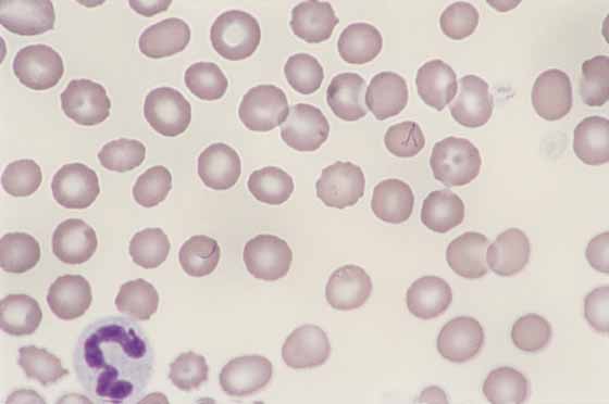 Canine blood. Chains of basophilic small coccoid organisms are noted on the surface of two RBCs. Haemobartonella canis causes a mild to moderate hemolytic anemia in dogs that have been splenectomized or treated with immunosuppressive drugs. 