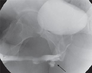 Paciente vítima de politrauma com fratura da pelve. A uretrocistografia retrógrada da uretra masculina evidencia o extravasamento do meio de contraste para os tecidos periuretrais, caracterizando uma rotura da uretra bulbar (apontado pela seta preta). 
