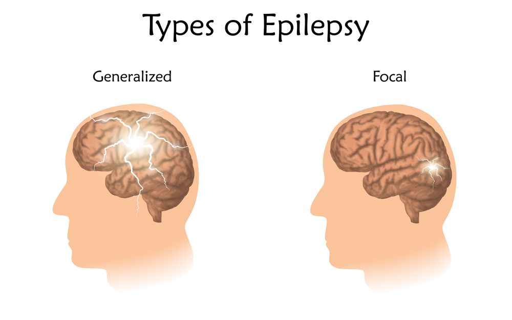 الصرع Epilepsy