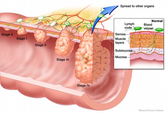 colon-cancer-stages.jpg