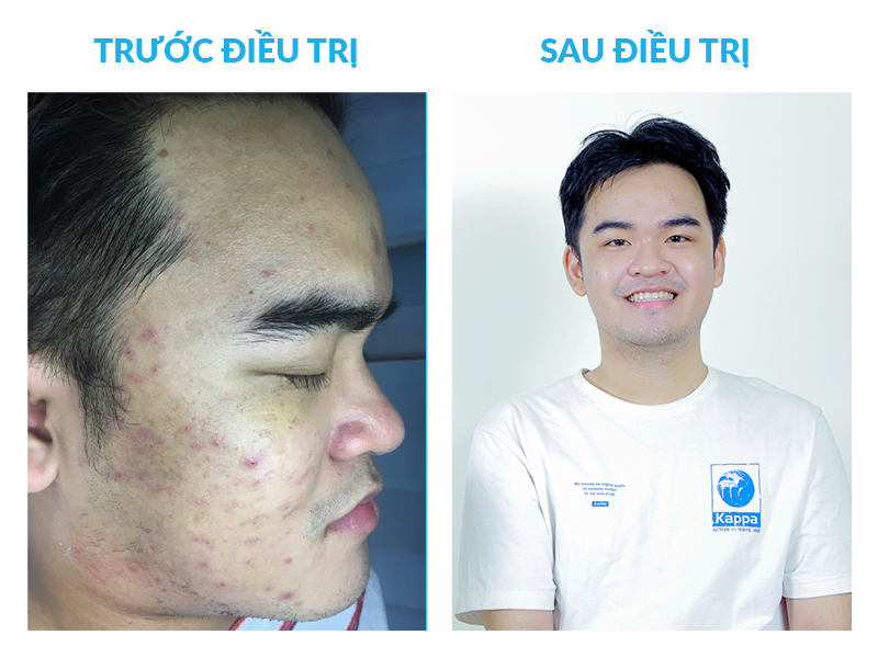 Nhựt Hào trước và sau khi điều trị mụn tại O2 SKIN