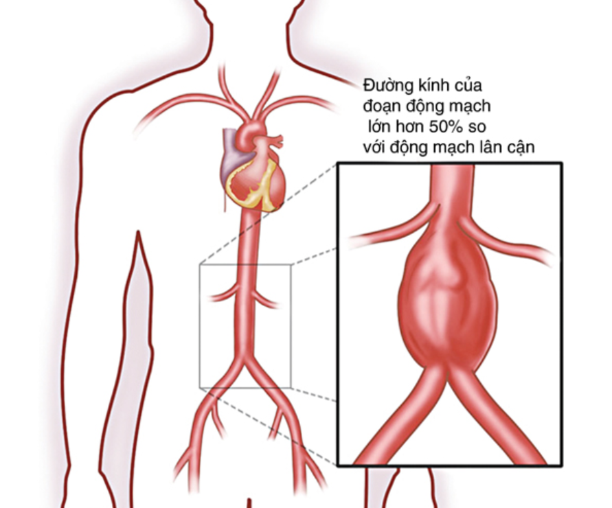 Phình động mạch chủ ảnh hưởng đến các cơ quan khác như thế nào? | Vinmec