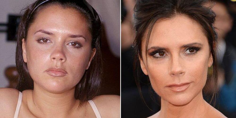 chirurgie esthétique de victoria beckham