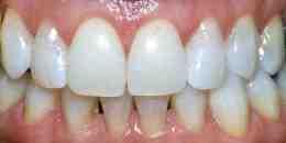 After Tooth Whitening