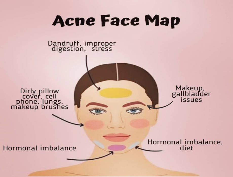 Top Causes of Acne on Cheeks, and How to Treat them - Seknd Blog