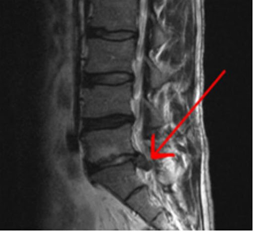 Hình ảnh thoát vị đĩa đệm bằng chụp cộng hưởng từ MRI