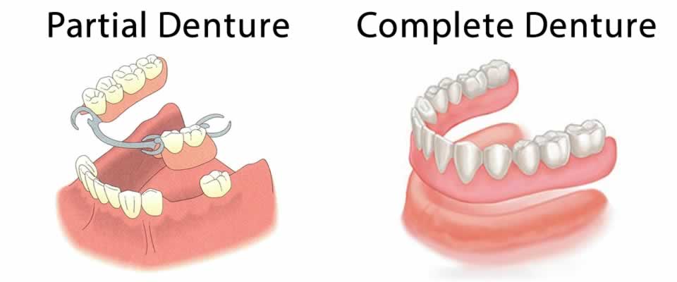 Dentures FAQ | Dentist Spring TX | Spring Complete Care Dentistry