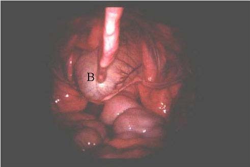 Laparoscopía en estación, vista caudal en el lado izquierdo. B: vejiga urinaria; flecha: ligamento lateral izquierdo de la vejiga.