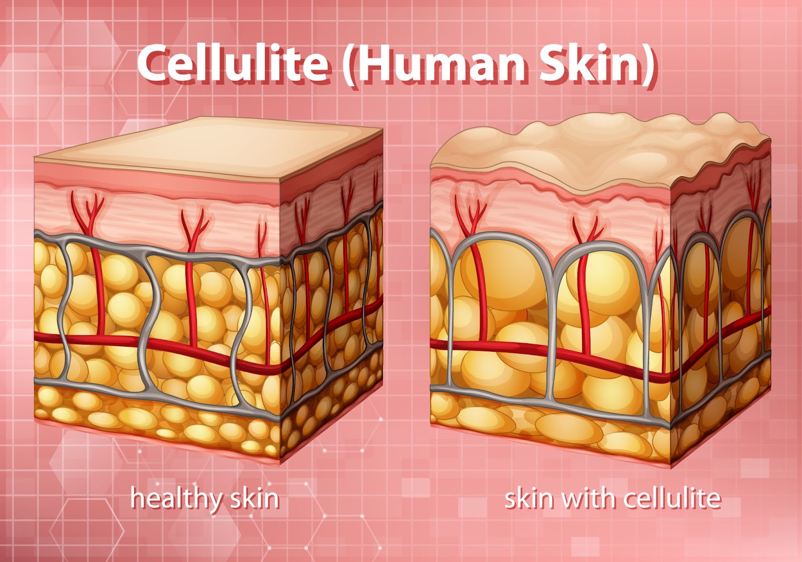 how cellulite looks like
