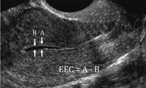 What Are The Reasons For Thin Endometrium?