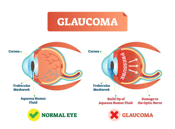 The Antonymy of normal eye and having a glaucoma eye 