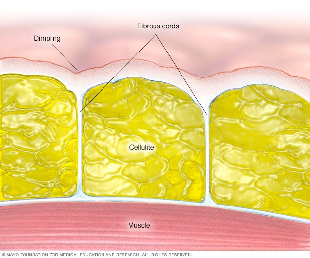 Anatomía de la celulitis