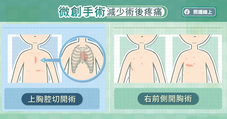 達文西開心手術３優點！醫分析心臟人工瓣膜如何選擇！