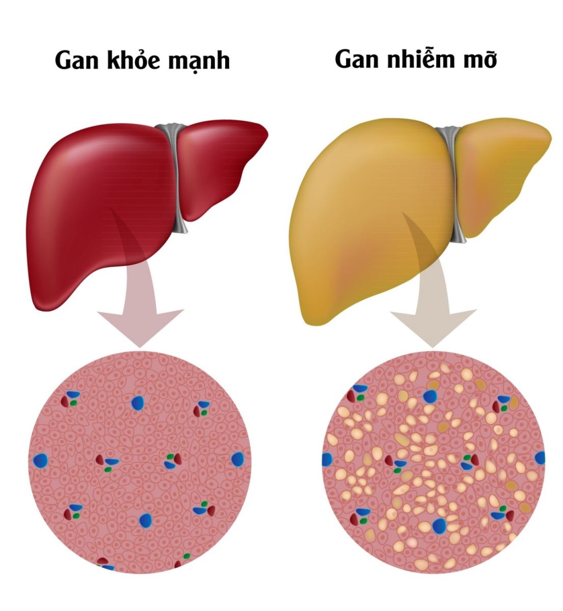 gan nhiễm mỡ có nguy hiểm không