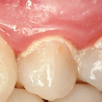 Các sản phẩm hữu ích - Nguyên nhân của chảy máu chân răng điều trị viêm chân răng