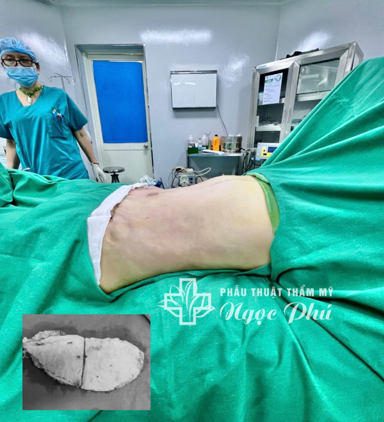 Hình ảnh khách hàng thực tế sau khi hút mỡ bụng và tạo hình thành bụng tại Bệnh viện Thẩm mỹ Ngọc Phú