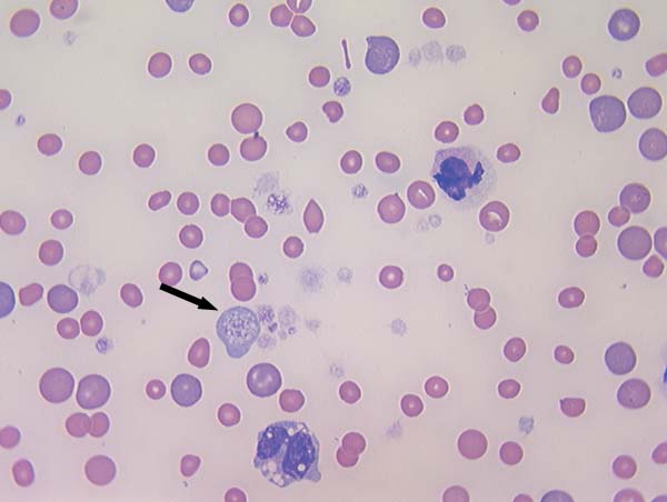 Feline blood smear in anemic patient. Note large blue-red cells (polychromatophils) throughout the field. Platelet anisocytosis is extreme with a bizarre macroplatelet in lower left quadrant (arrow) suggesting developmental defect and need for bone marrow examination (50x).