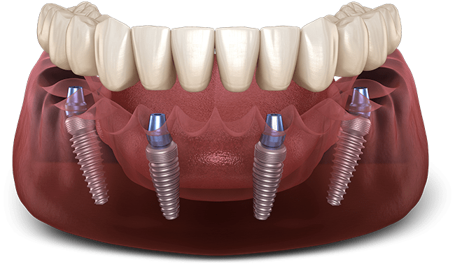 ایمپلنت کامل دندان (ایمپلنت فک بالا و پایین)