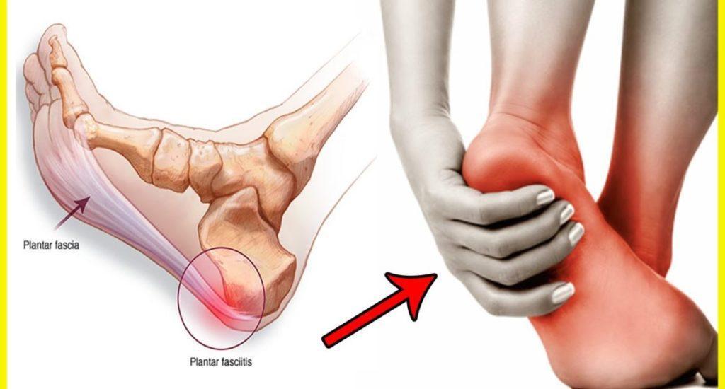 How Can Plantar Fasciitis be Treated Without Drugs, Insoles ...