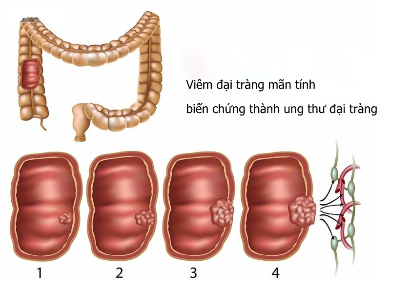 Biến chứng của viêm đại tràng