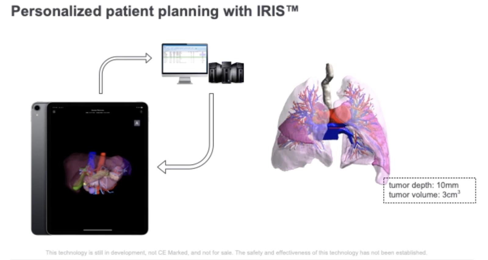 Personalized patient planning with IRIS