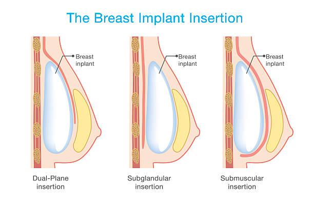 1000 cc implants