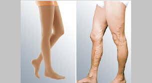 Thigh-highs for men with medical conditions