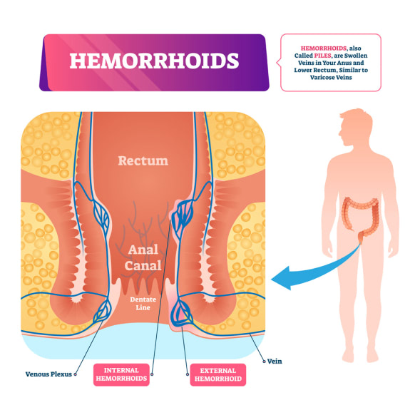 What are hemorrhoid infographic