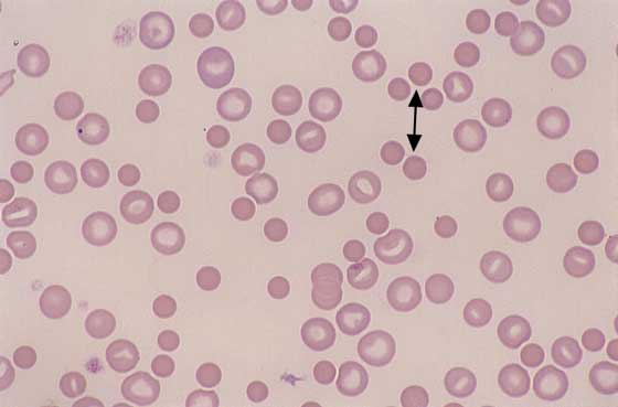 RBCs from dog with immune-mediated hemolytic anemia. Anisocytosis is marked due to the presence of macro- cytic polychromatophilic erythrocytes and spherocytes (arrow) which are the smaller cells that lack the normal central pallor (60x).