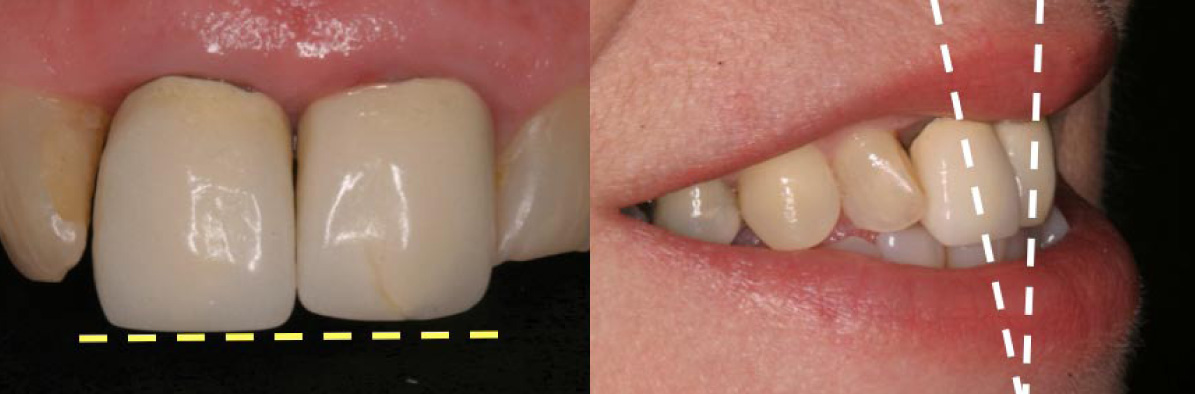 Horizontal position of the edges of your front teeth