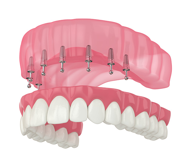 Snap-in Dentures - Eva Boldridge DMD PA Houston Texas