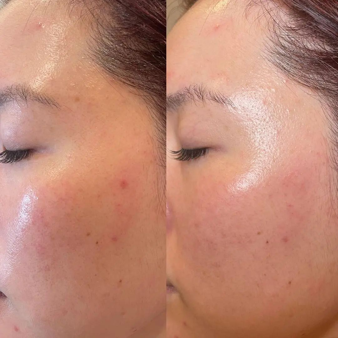 Hydrafacial customized to remove skin congestion - Results immediately after treatment