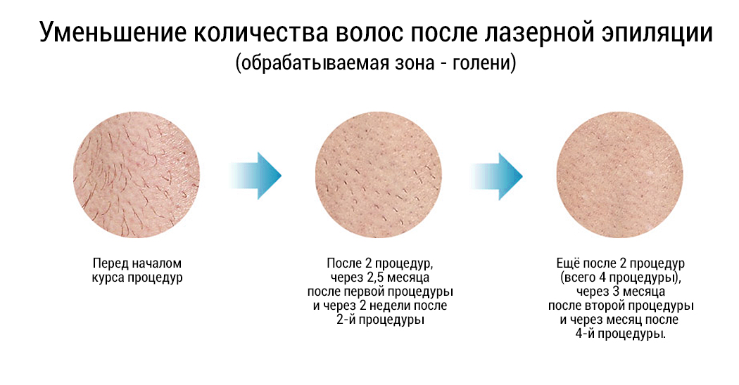 Лазерное удаление волос голени