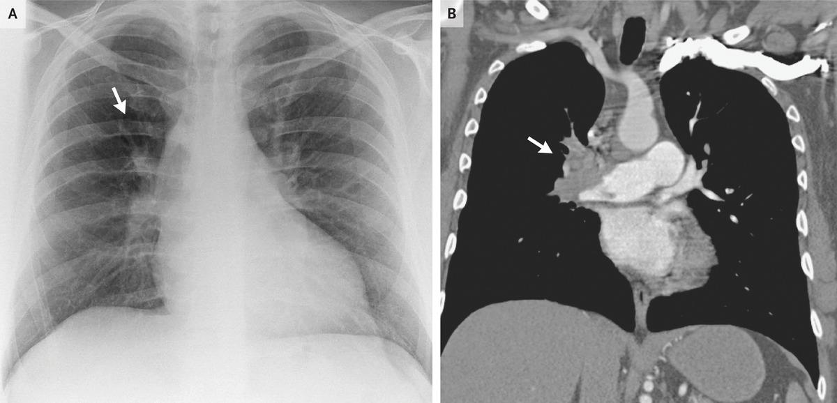 Westermark Sign in Pulmonary Embolism | NEJM
