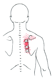 rhomboid trigger point diagram