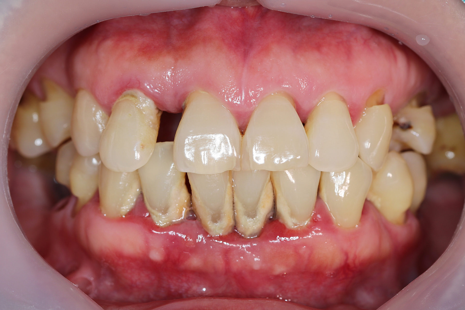 Very unhealthy gums leading to bone loss